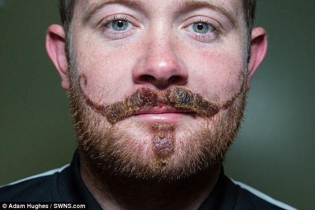 Временная тату оставила сильные шрамы на лице парня