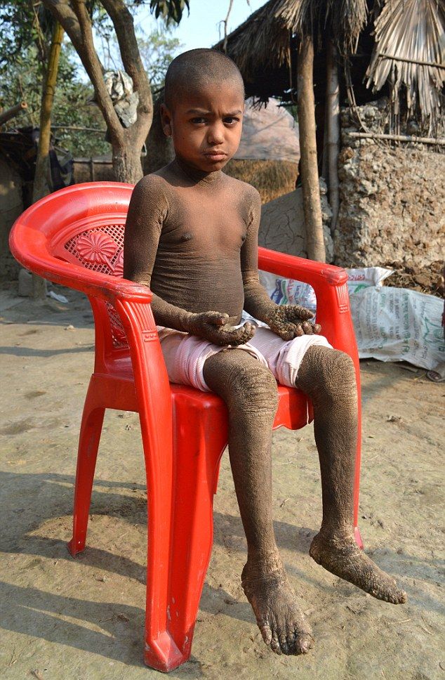 Врачи не знают, как помочь каменеющему мальчику из Бангладеш