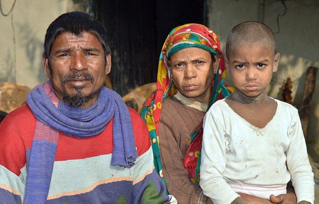 Врачи не знают, как помочь каменеющему мальчику из Бангладеш