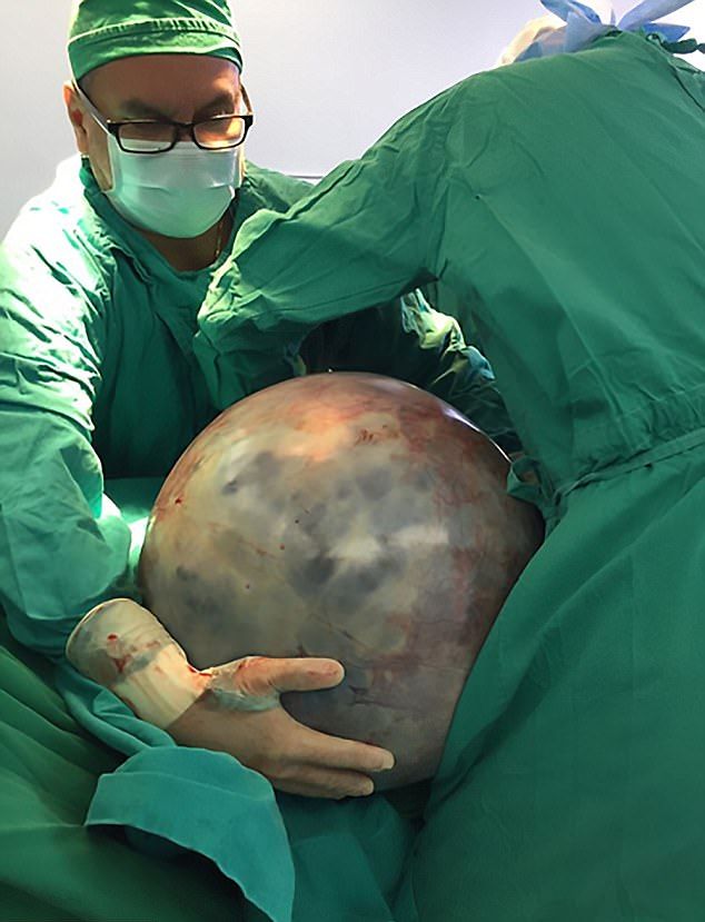 Из пожилой женщины вырезали опухоль весом 32 кг, которую она вынашивала восемь лет