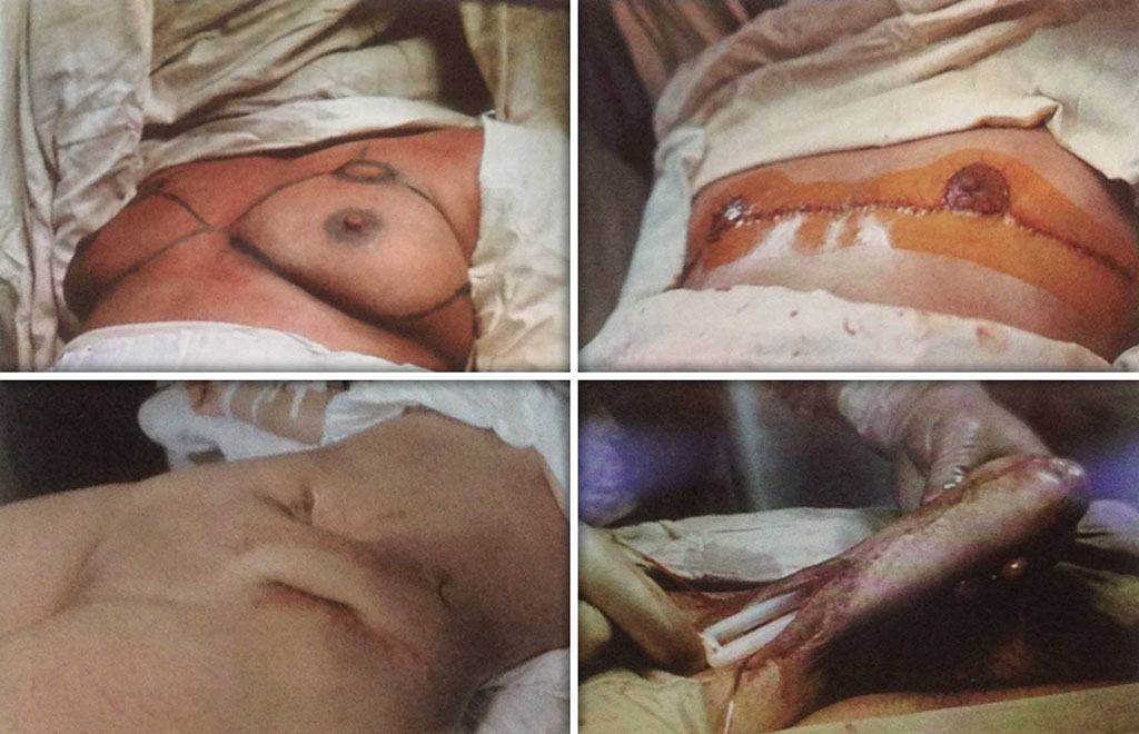 Я передумала: история первой операции по смене пола Я передумала: история первой операции по смене пола