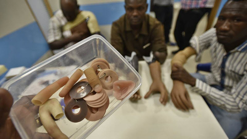 3D-печать протезов приходит в Индию