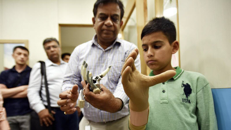 3D-печать протезов приходит в Индию