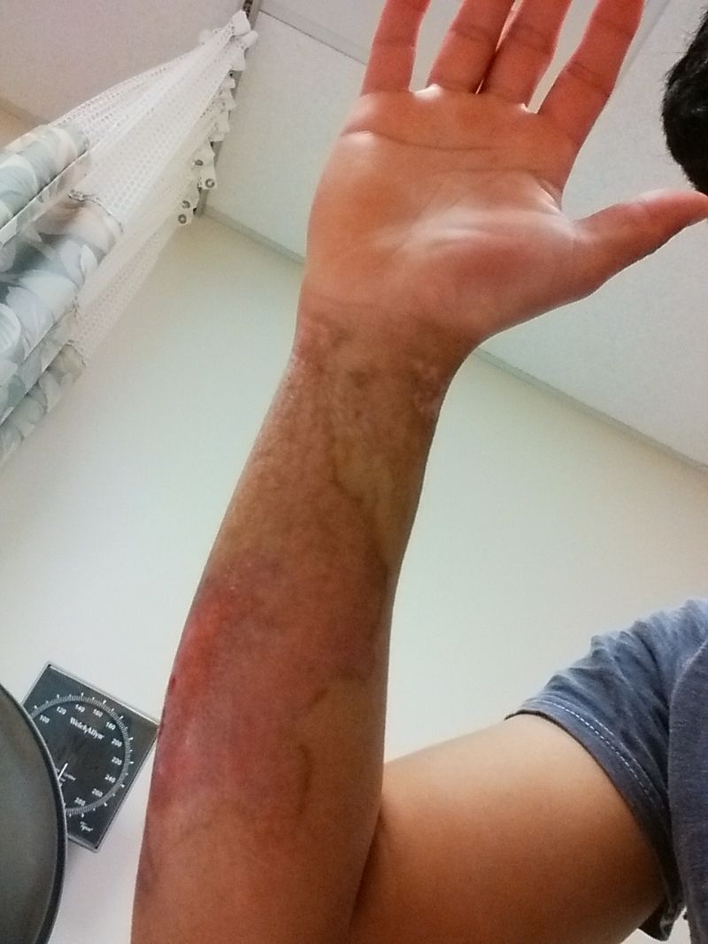 Сварил руку во фритюрнице (17 фото)