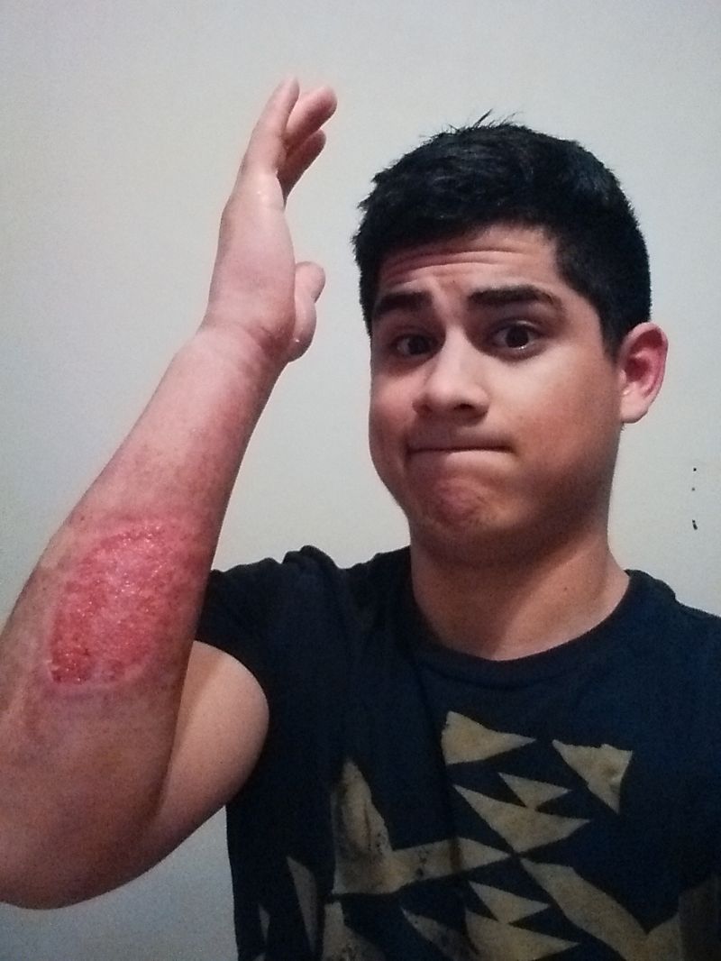 Сварил руку во фритюрнице (17 фото)