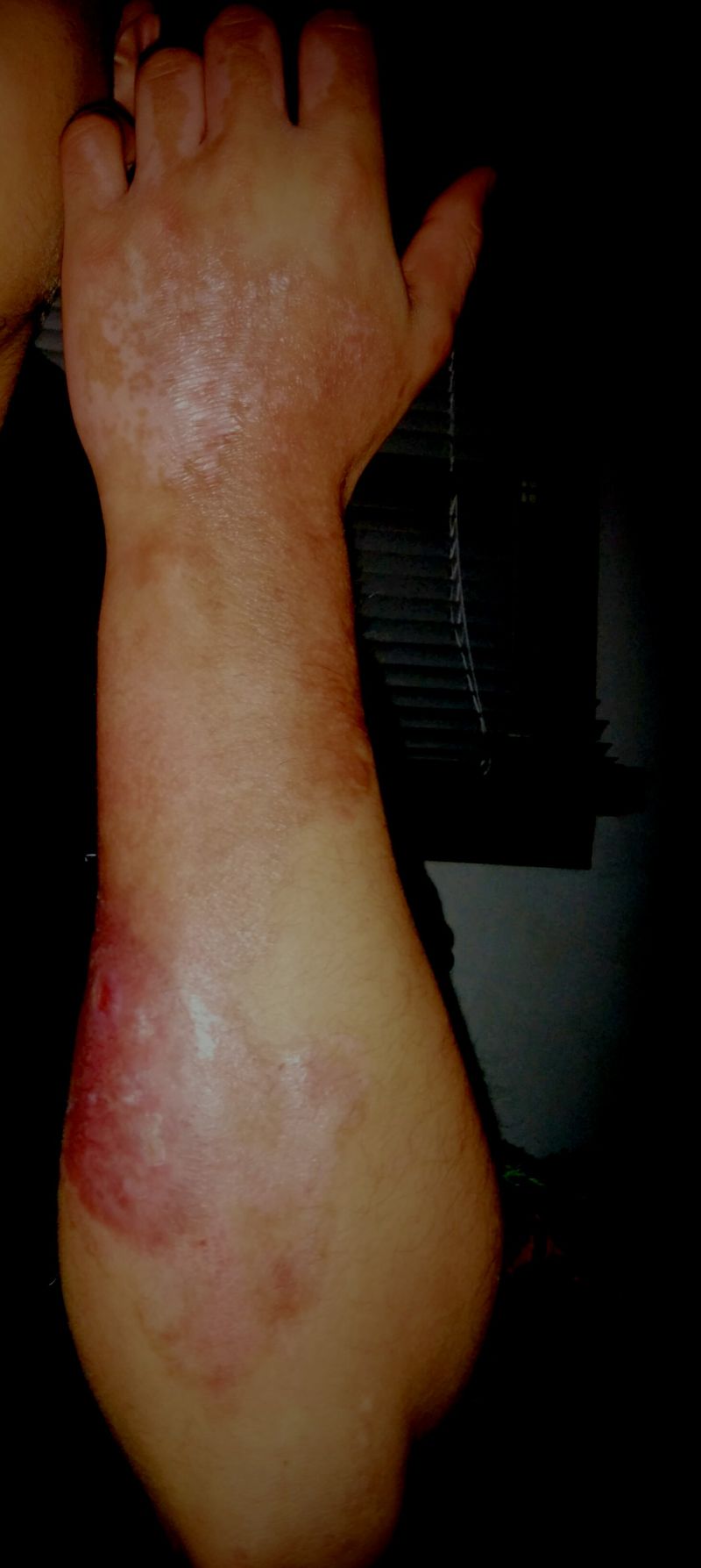 Сварил руку во фритюрнице (17 фото)