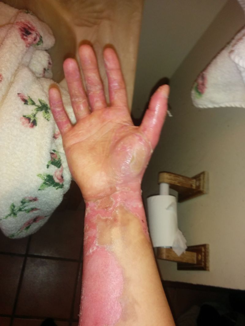 Сварил руку во фритюрнице (17 фото)