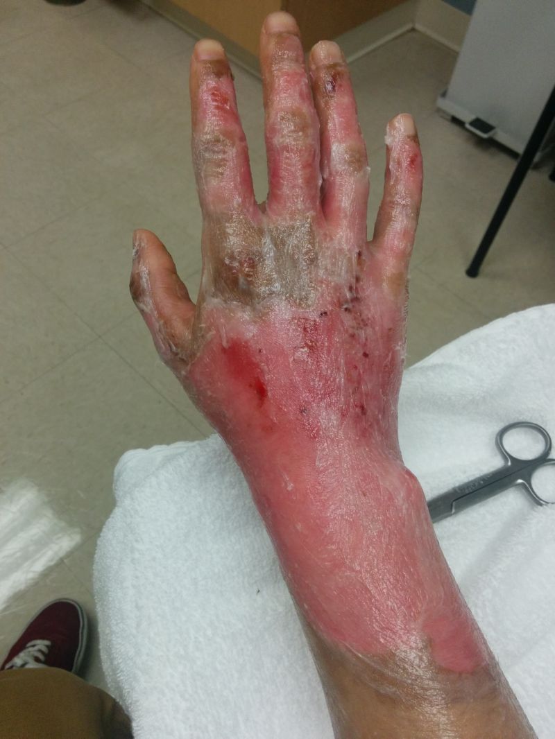 Сварил руку во фритюрнице (17 фото)