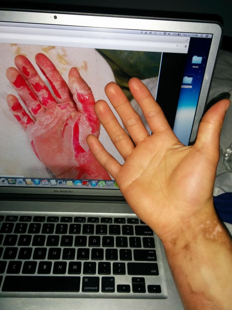 Сварил руку во фритюрнице (17 фото)