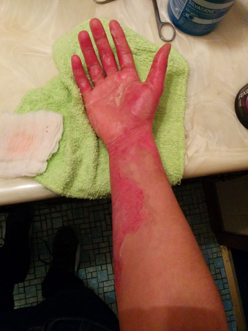 Сварил руку во фритюрнице (17 фото)
