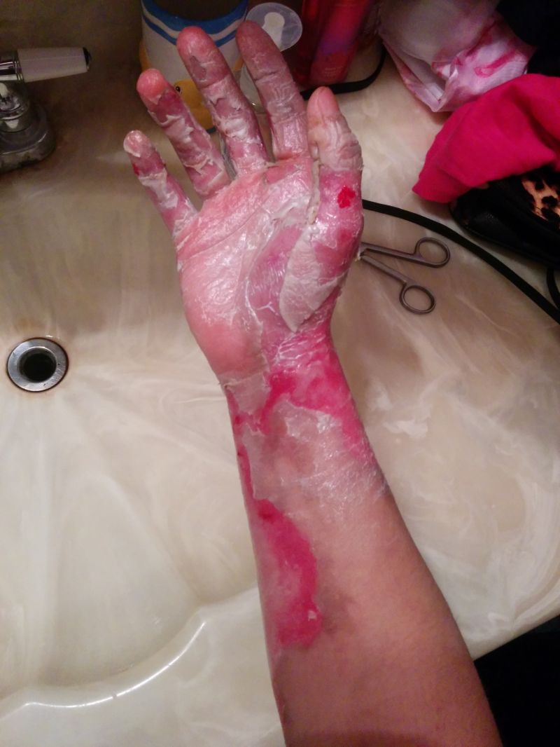 Сварил руку во фритюрнице (17 фото)