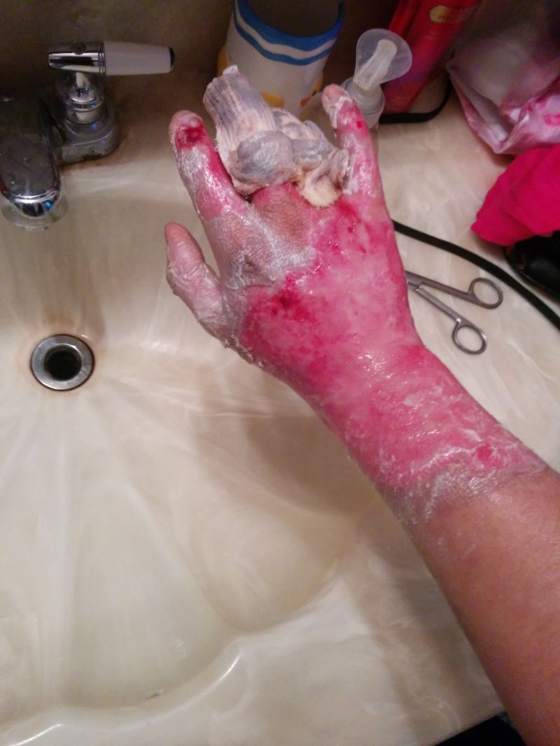 Сварил руку во фритюрнице (17 фото)