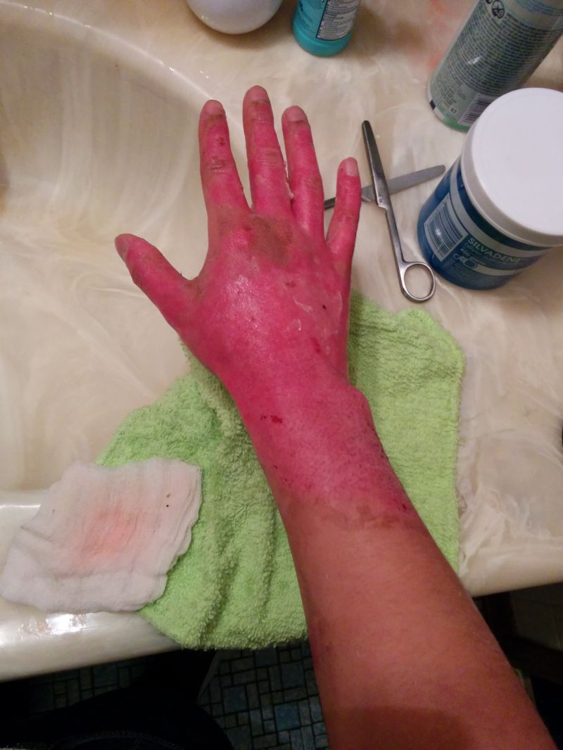 Сварил руку во фритюрнице (17 фото)