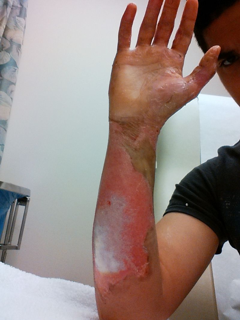 Сварил руку во фритюрнице (17 фото)