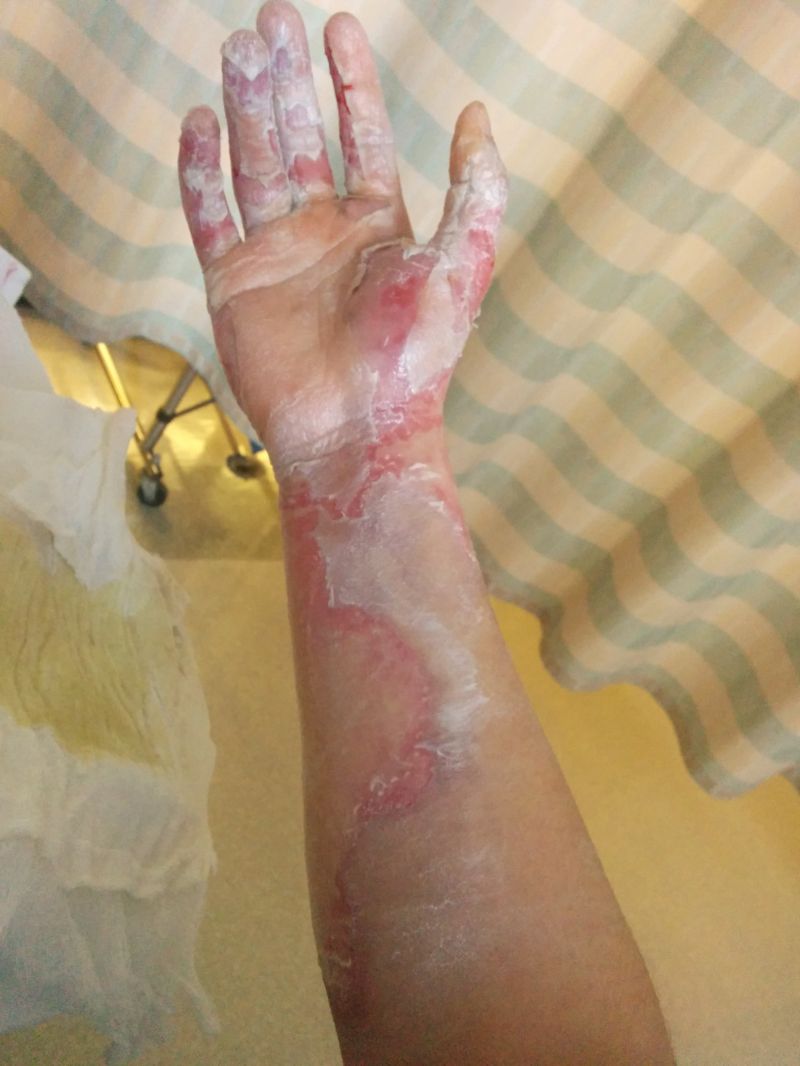 Сварил руку во фритюрнице (17 фото)