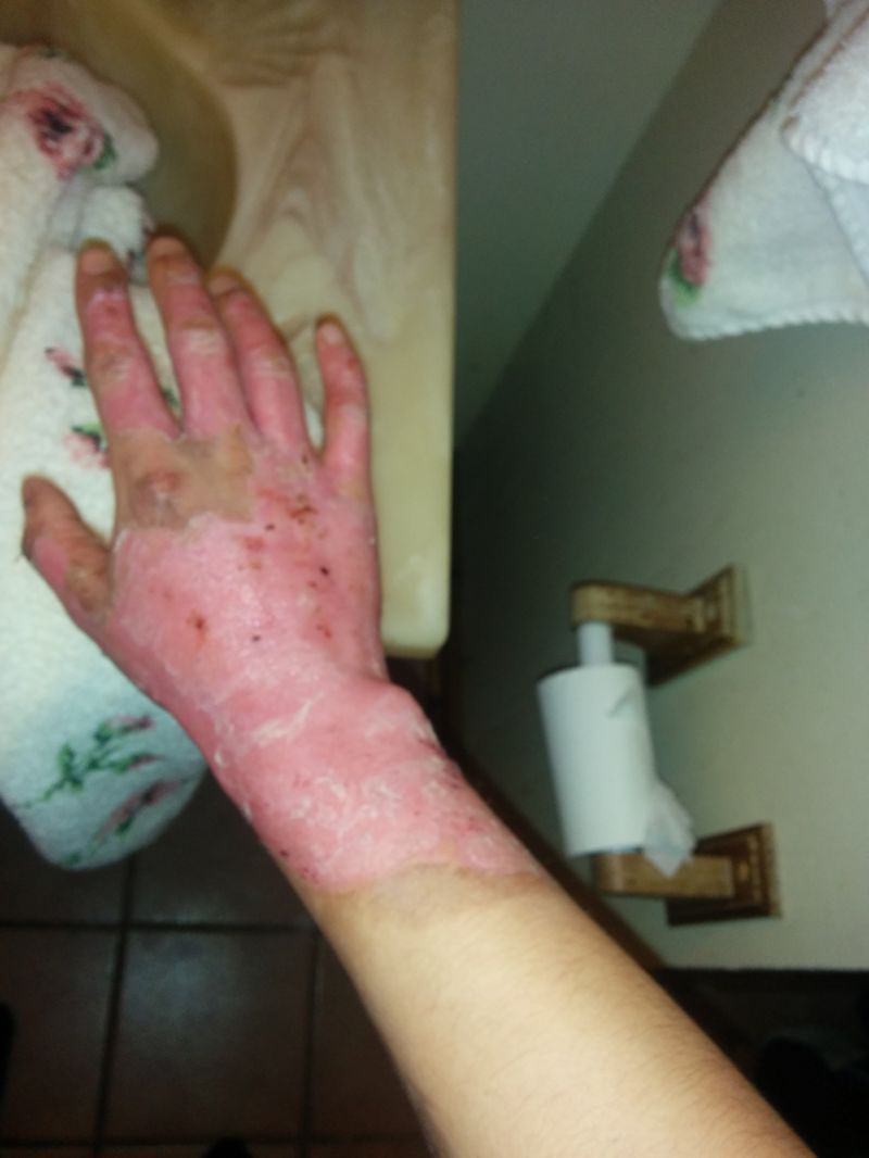 Сварил руку во фритюрнице (17 фото)