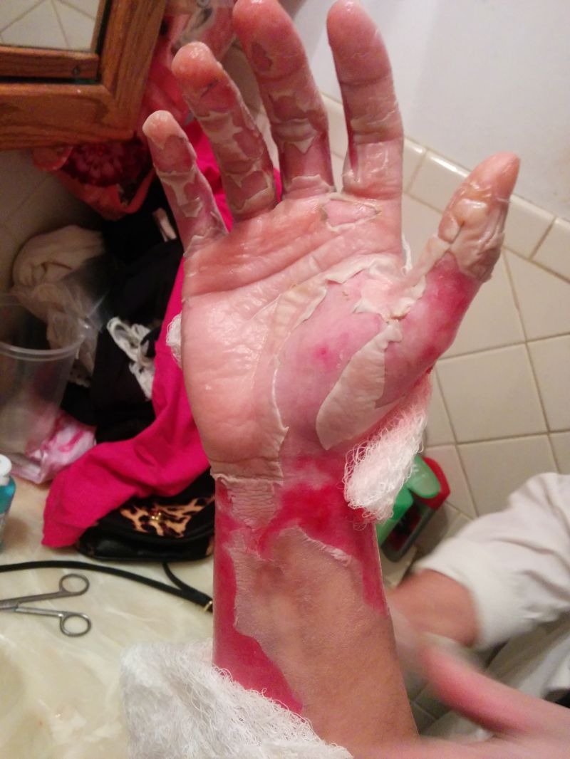 Сварил руку во фритюрнице (17 фото)