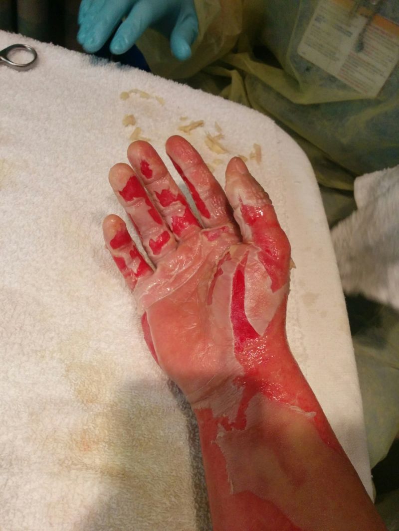 Сварил руку во фритюрнице (17 фото)