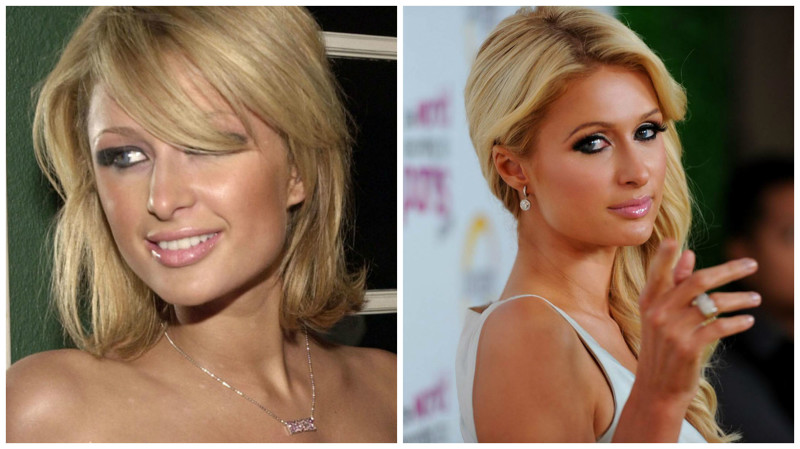 Знаменитости, которым пластические операции пошли на пользу Знаменитости, которым пластические операции пошли на пользу