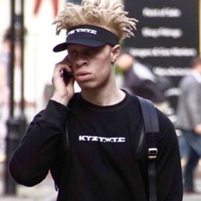 Альбинос, родившийся у чернокожих родителей, стал моделью и поддерживает таких же детишек