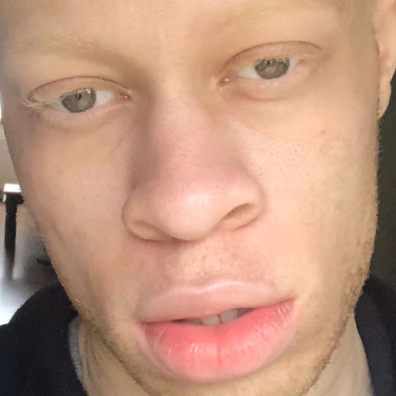 Альбинос, родившийся у чернокожих родителей, стал моделью и поддерживает таких же детишек