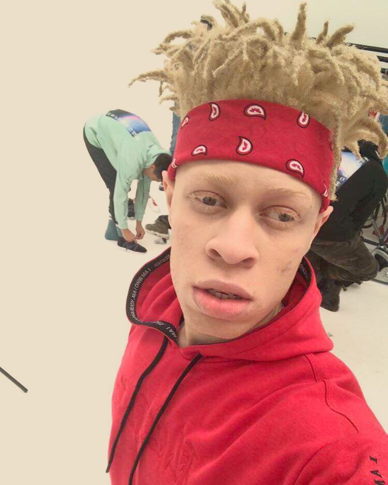 Альбинос, родившийся у чернокожих родителей, стал моделью и поддерживает таких же детишек