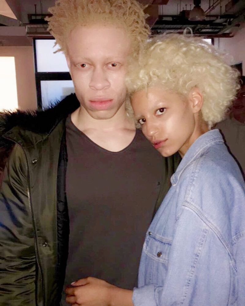 Альбинос, родившийся у чернокожих родителей, стал моделью и поддерживает таких же детишек