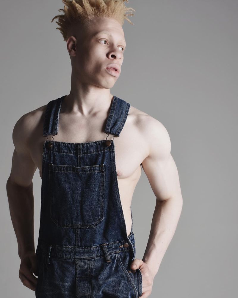 Альбинос, родившийся у чернокожих родителей, стал моделью и поддерживает таких же детишек