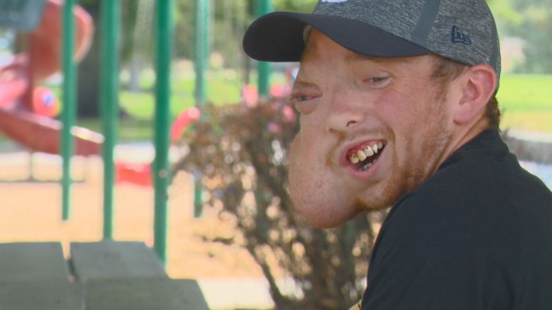 Парню с огромной опухолью на лице до и после операции