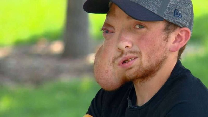 Парню с огромной опухолью на лице до и после операции