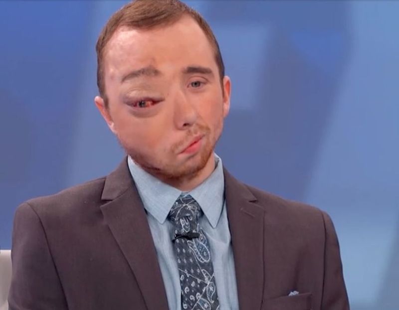 Парню с огромной опухолью на лице до и после операции