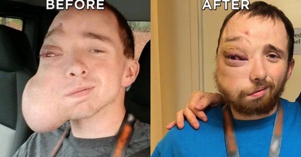 Парню с огромной опухолью на лице до и после операции