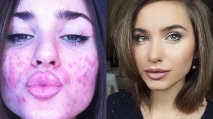 До и после акне: 5 реальных историй девушек, которые смогли победить прыщи