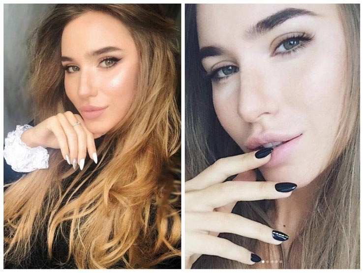 До и после акне: 5 реальных историй девушек, которые смогли победить прыщи