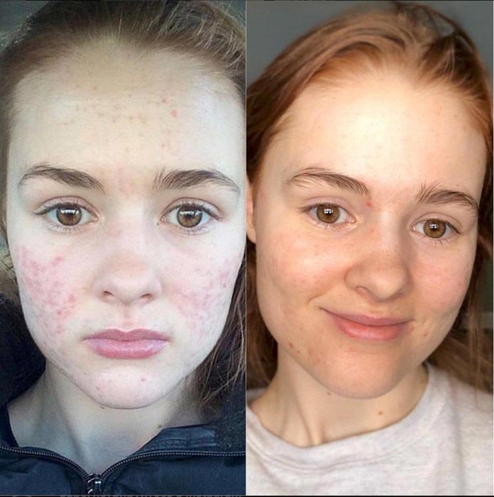 До и после акне: 5 реальных историй девушек, которые смогли победить прыщи