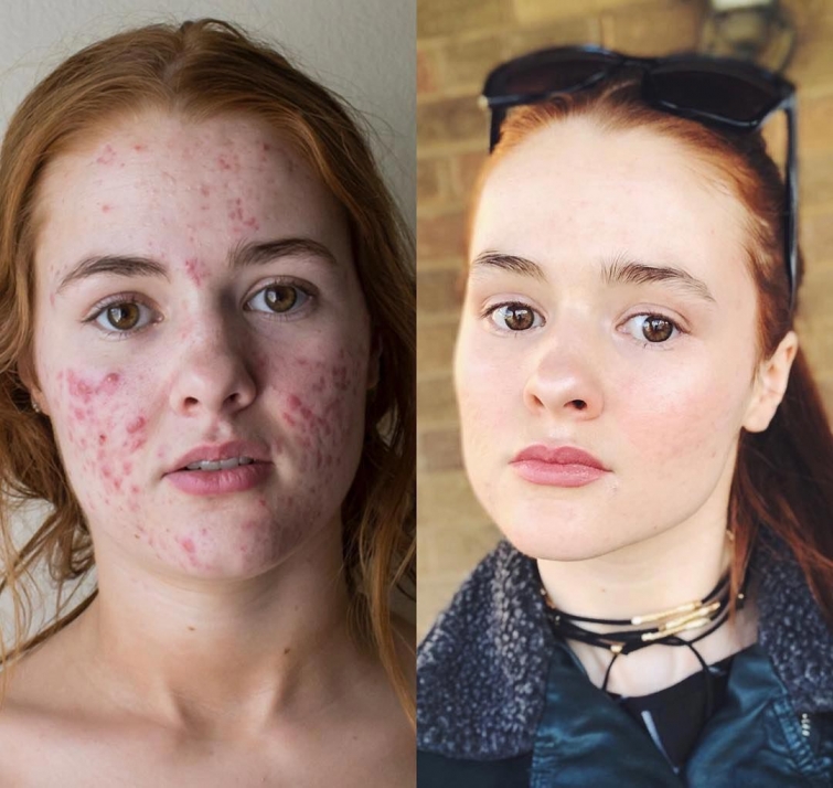 До и после акне: 5 реальных историй девушек, которые смогли победить прыщи