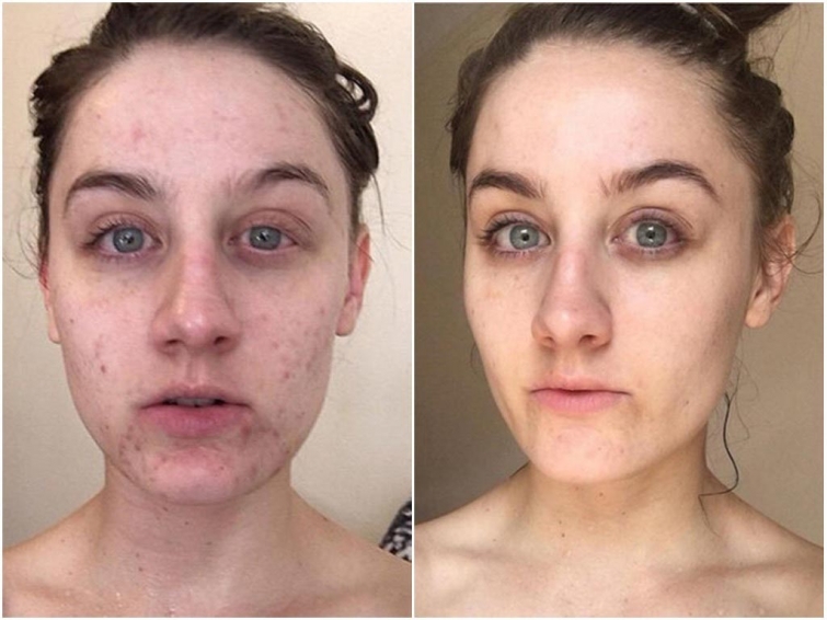 До и после акне: 5 реальных историй девушек, которые смогли победить прыщи