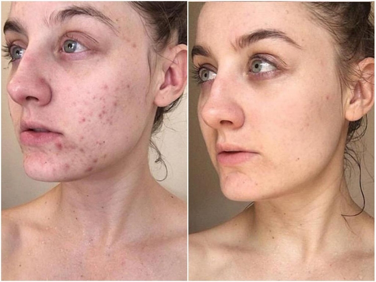 До и после акне: 5 реальных историй девушек, которые смогли победить прыщи