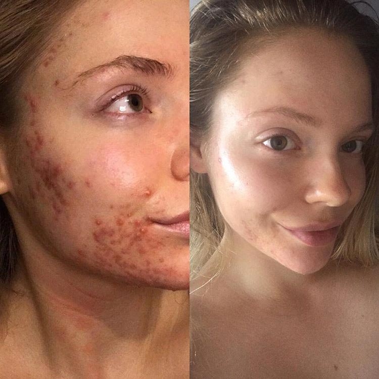 До и после акне: 5 реальных историй девушек, которые смогли победить прыщи