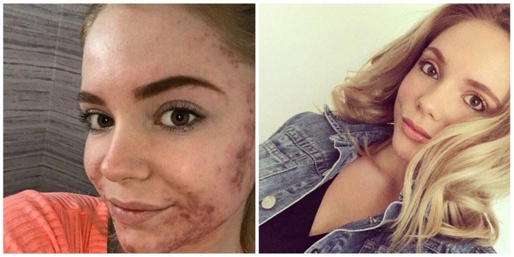 До и после акне: 5 реальных историй девушек, которые смогли победить прыщи