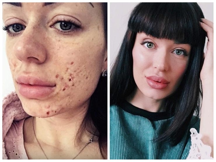 До и после акне: 5 реальных историй девушек, которые смогли победить прыщи