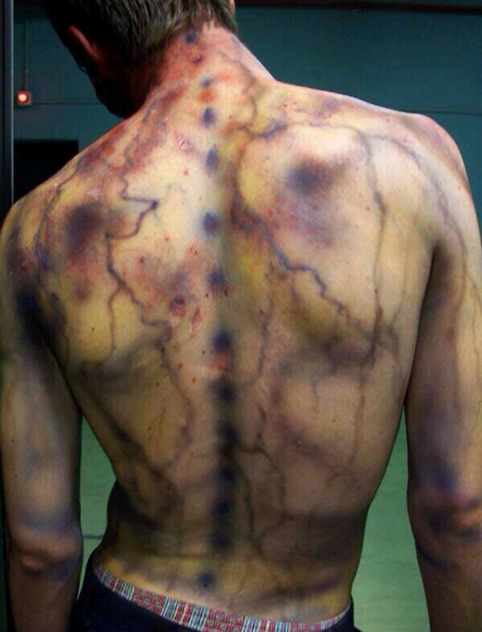 Что случается с человеком после удара молнии Что случается с человеком после удара молнии