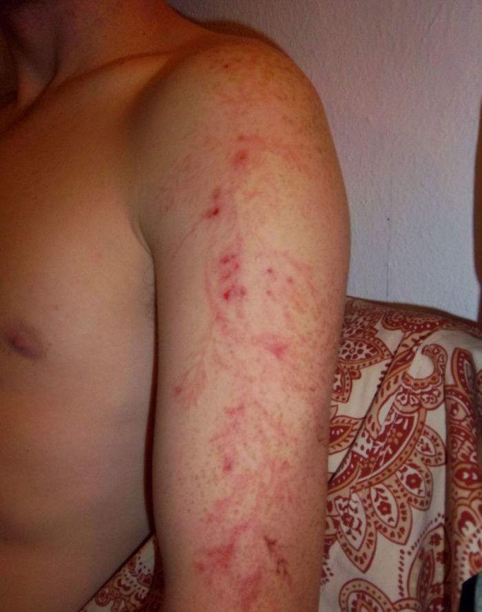 Что случается с человеком после удара молнии Что случается с человеком после удара молнии