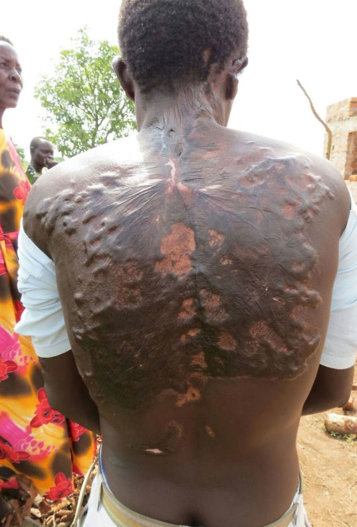 Что случается с человеком после удара молнии Что случается с человеком после удара молнии