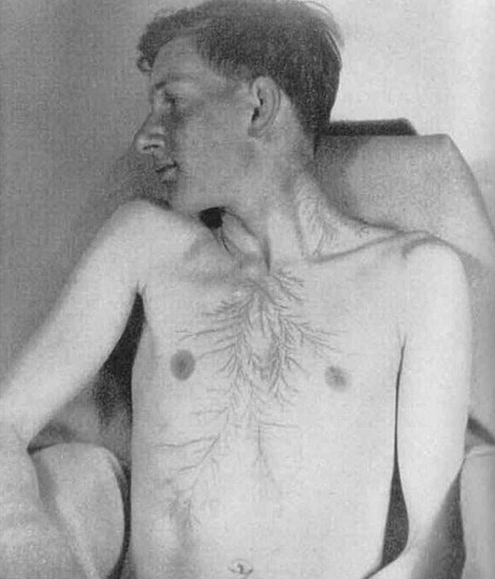 Что случается с человеком после удара молнии Что случается с человеком после удара молнии