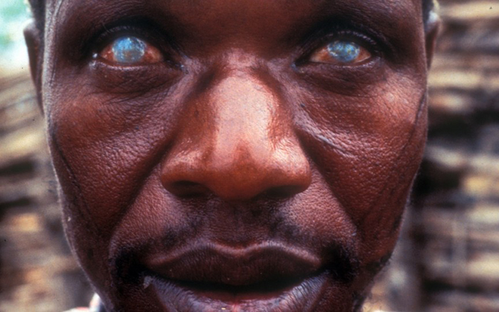 10 самых страшных паразитов, которые могут жить в человеческом теле