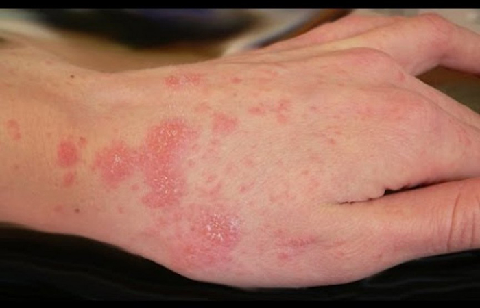 10 самых страшных паразитов, которые могут жить в человеческом теле