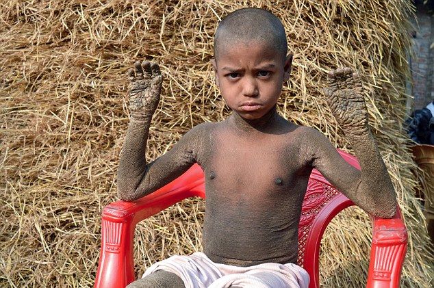 Врачи не знают, как помочь каменеющему мальчику из Бангладеш