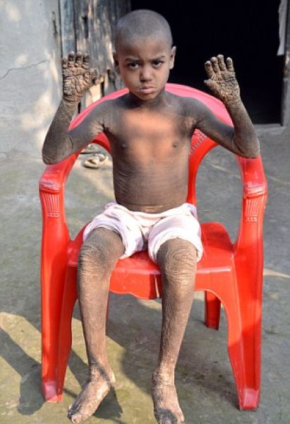 Врачи не знают, как помочь каменеющему мальчику из Бангладеш