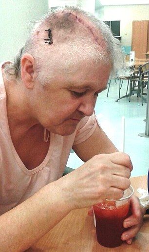 Женщина осталась без половины головы после того, как попала под автобус